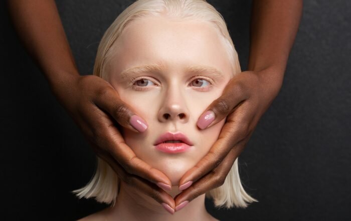 phototypes peau traitement laser